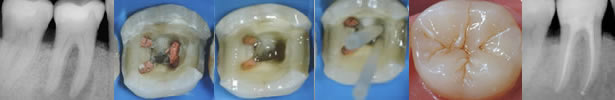 Endodonzia - Dental Clinic Torino